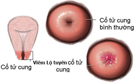 Bệnh lộ tuyến cổ tử cung là gì